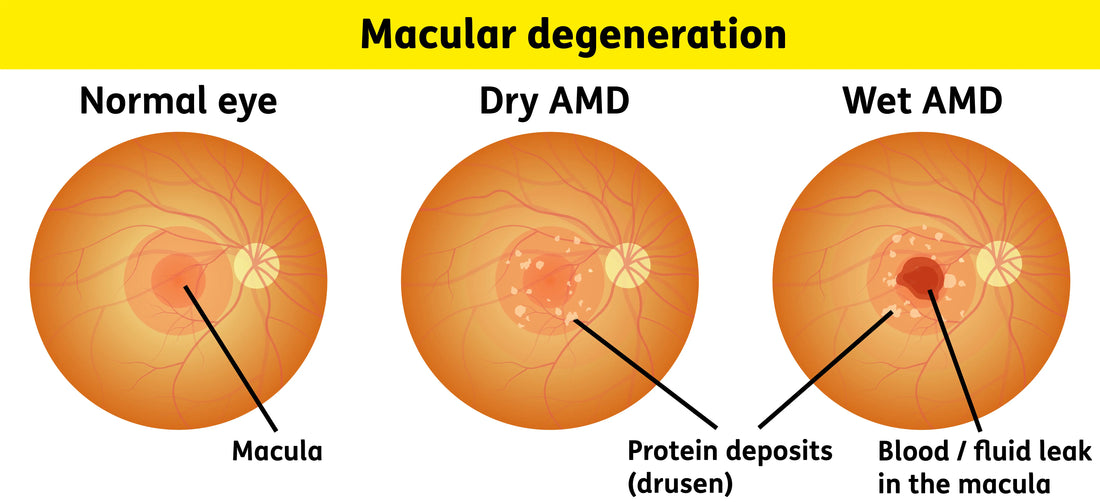 Dry vs. Wet Macular Degeneration: What's Actually Happening in Your Eye?