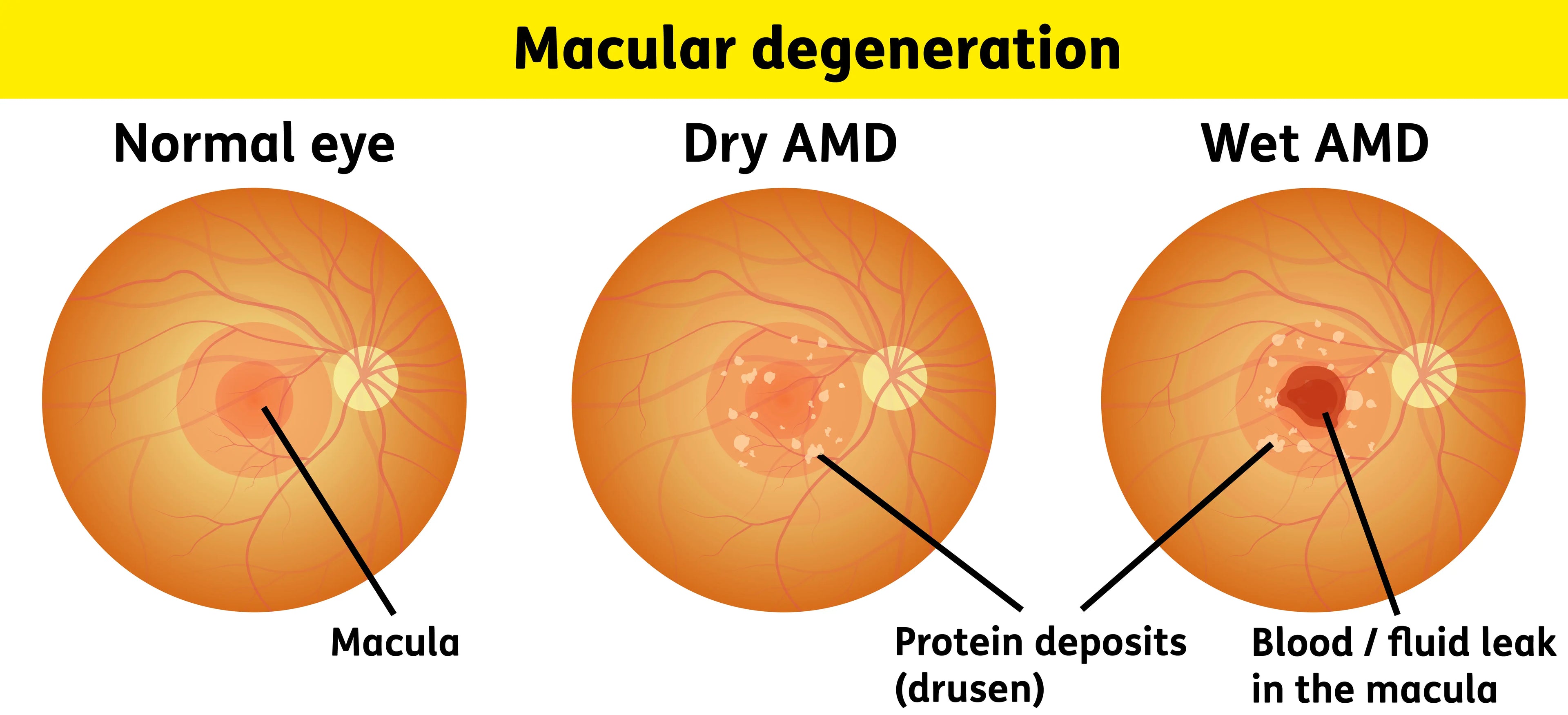 Dry vs. Wet Macular Degeneration: What's Actually Happening in Your Eye?