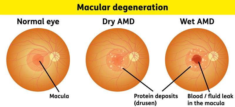 Dry vs. Wet Macular Degeneration: What's Actually Happening in Your Eye?