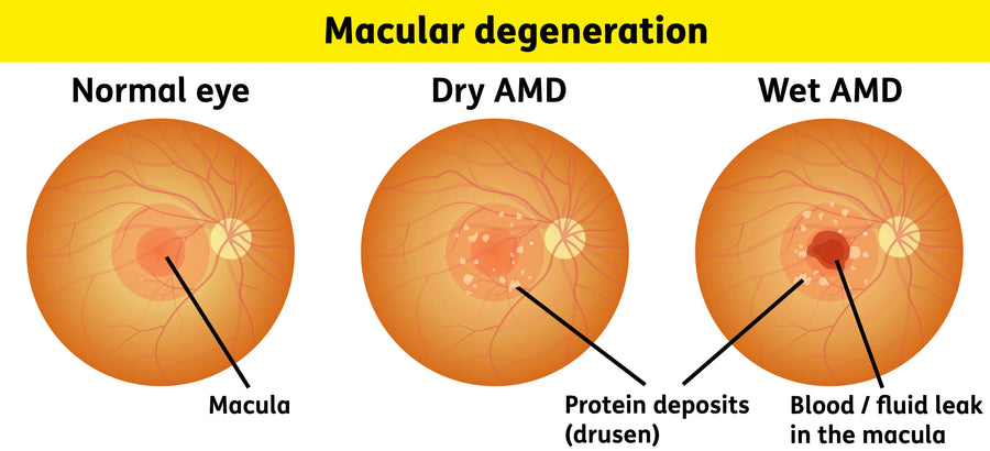 Dry vs. Wet Macular Degeneration: What's Actually Happening in Your Eye?